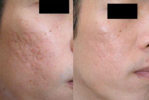 Dùng thuốc gì để trị sẹo thủy đậu cho nam