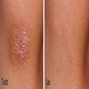 Bất ngờ với các cách trị sẹo thâm từ dân gian