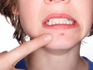 Bị mụn có nên dùng serum dưỡng da?