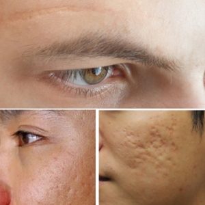 5 cách trị sẹo trên mặt cực hay
